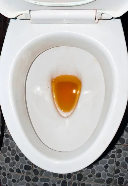 Высокоцветная Моча Туалете Высокоцветная Моча Встречается Гепатите Лептоспирозе Гемолитических Заболеваниях — стоковое фото
