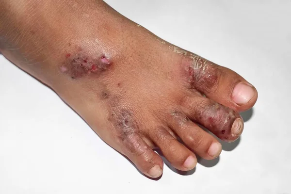 Scabies Infestation Secondary Superimposed Bacterial Infection Pustules Foot Southeast Asian — 图库照片