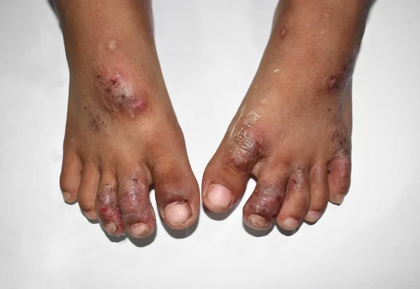 Scabies Infestation Secondary Superimposed Bacterial Infection Pustules Foot Southeast Asian — 图库照片