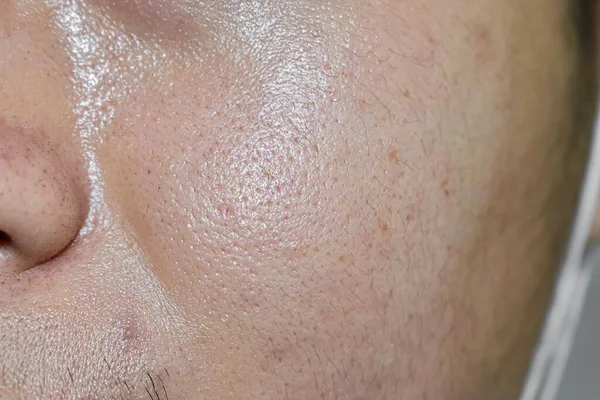 기름지고 동남아시아 미얀마 한국의 남성의 기름기있는 피부는 내분비선 비로인한 것이다 — 스톡 사진