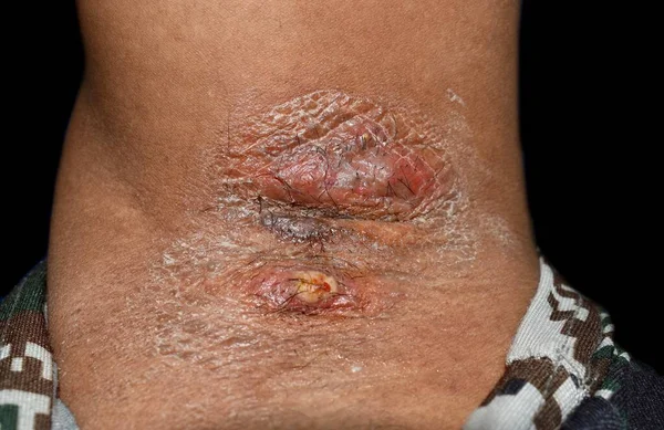 Karbunkel Und Follikulitis Mit Umgebender Cellulitis Oder Staphylokokken Streptokokken Hautinfektion — Stockfoto