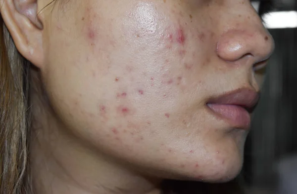 acne vulgaris and scars over whole face of Southeast Asian woman. Acne occurs when hair follicles become plugged with oil and dead cells. It causes whiteheads, blackheads or pimples.