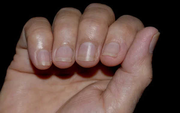 Ridges for nails Stock Photos, Royalty Free Ridges for nails Images | Depositphotos Ridges for nails Stock Photos, Royalty Free Ridges for nails Images | Depositphotos