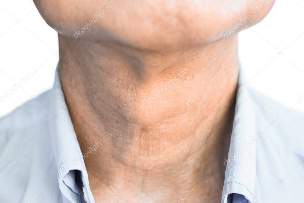 Smooth, diffuse thyroid swelling of Southeast Asian, Myanmar or Burmese young man. A goiter can occur with hypothyroidism or hyperthyroidism. It can sometimes also result from tumors or nodules.