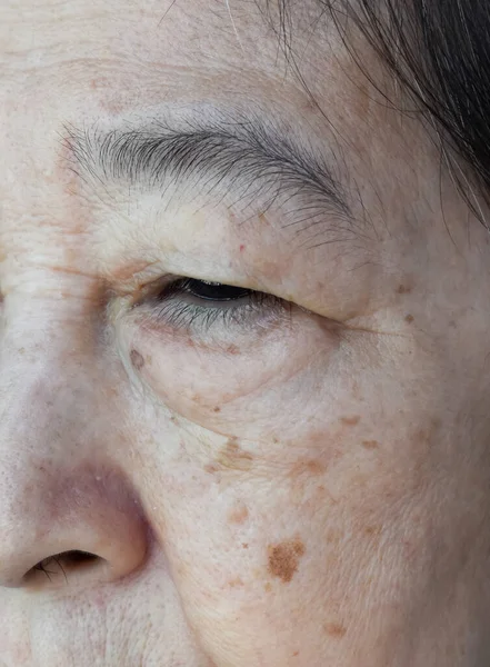 Γήρανση Του Δέρματος Πτυχώσεις Ρυτίδες Του Δέρματος Ρυτίδες Και Κηλίδες — Φωτογραφία Αρχείου
