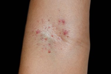 Asyalı çocukta kübital fossa bölgesinde küçük kırmızı noktalar ya da peteşi grubu. Hess testi ya da turnike testi pozitif ve en azından birinci derece dang. Siyah arkaplanda izole
