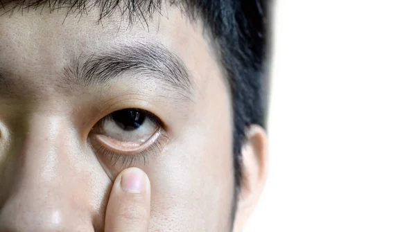 Pale Skin Asian Man Sign Anemia Pallor Eyelid Isolated White — Stock Photo, Image