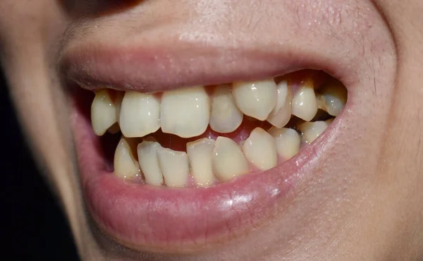 Stacked or impacted teeth of Asian man. Also called crowded tooth. Closeup view.