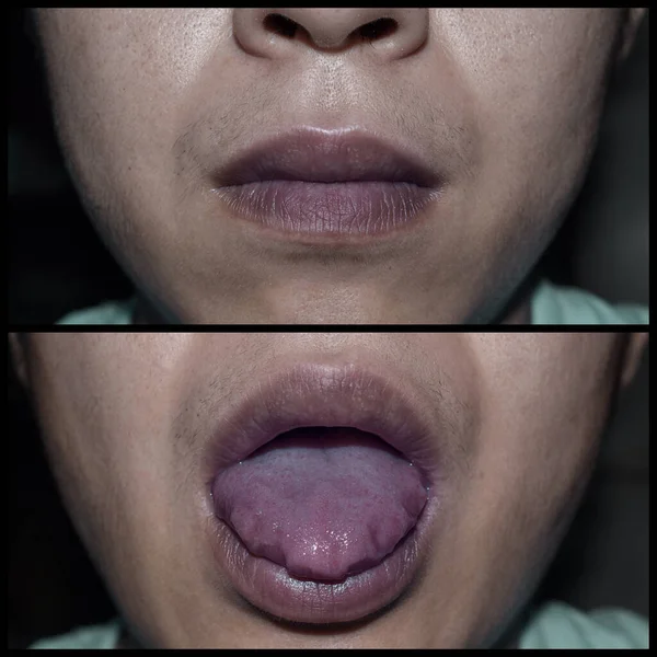 Labios Cianóticos Cianosis Central Sudeste Asiático Joven Chino Con Enfermedad —  Fotos de Stock