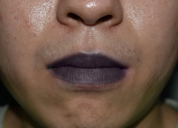 东南亚的青色嘴唇或中央发紫 中国年轻人先天性心脏病 闭包视图 — 图库照片