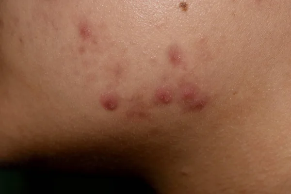 Acne Vulgaris Svarta Fläckar Och Ärr Ansiktet Asiatisk Ung Kvinna — Stockfoto