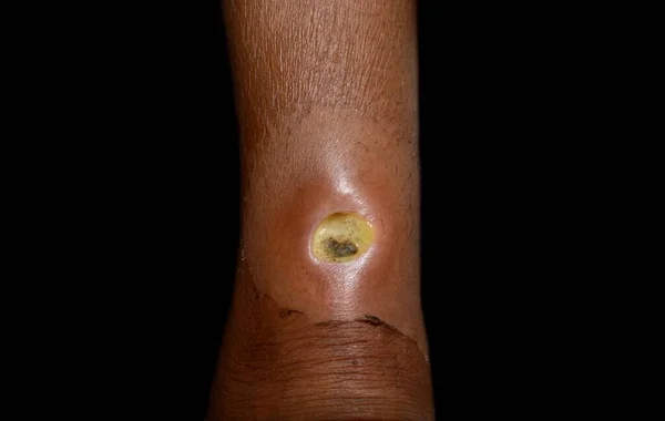 Asya Bacağında Diyabetik Ülser Sabırlı Kötü Iyileşme Siyah Üzerine Izole — Stok fotoğraf