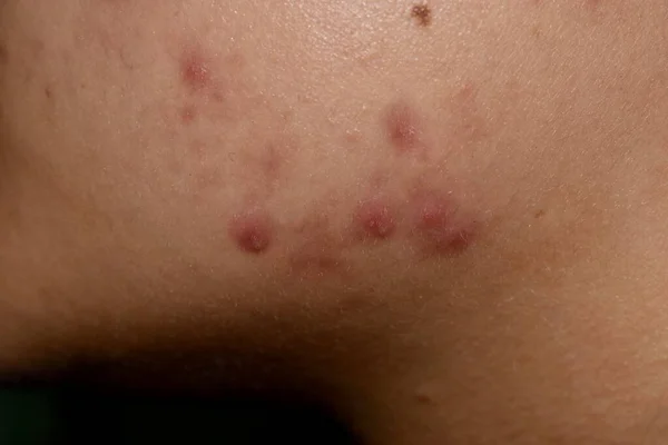 Acne Vulgaris Black Spots Scars Face Asian Young Woman Closeup — Stock Photo, Image