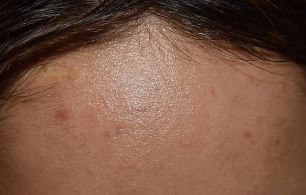 Oily skin with wide forehead of Southeast Asian, Myanmar or Korean adult young woman. Closeup view.
