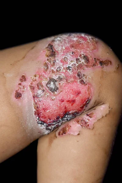Burn Wound Surrounded Scabs Exsudates Thigh Southeast Asian Child Closeup — Stock Photo, Image