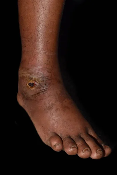 亚裔缅甸男性患者下肢的溃疡 即将发生的脓肿和结肠炎或葡萄球菌感染 链球菌皮肤感染 趾高气扬 — 图库照片