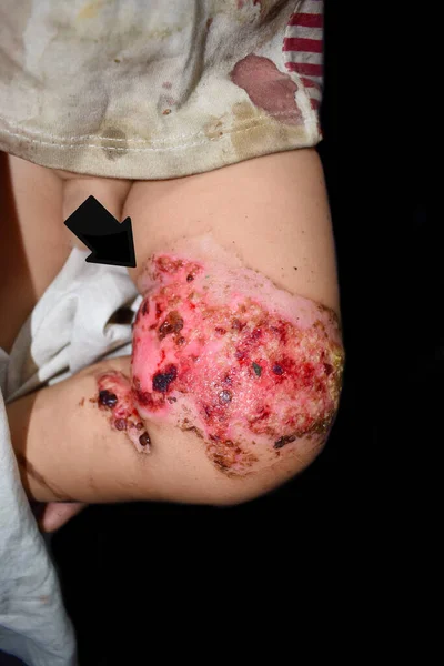 Blessure Par Brûlure Entourée Croûtes Exsude Dans Cuisse Enfant Asie — Photo