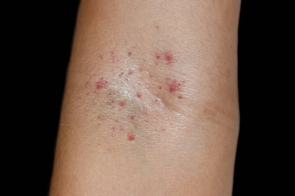 Asyalı çocukta kübital fossa bölgesinde küçük kırmızı noktalar ya da peteşi grubu. Hess testi ya da turnike testi pozitif ve en azından birinci derece dang. Siyah arkaplanda izole