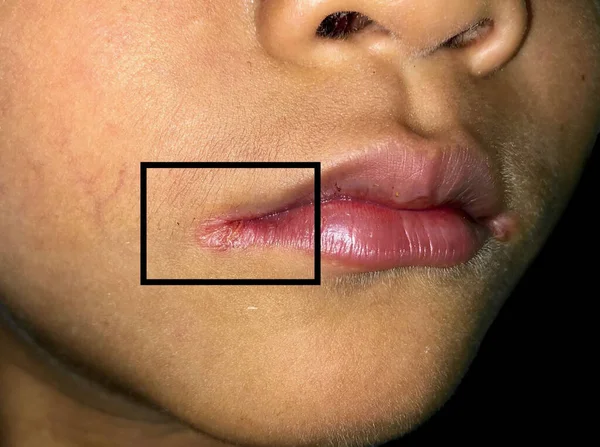 Angulaire Stomatitis Hoekige Cheilitis Perleche Bij Aziatische Kleine Jongen Vaak — Stockfoto