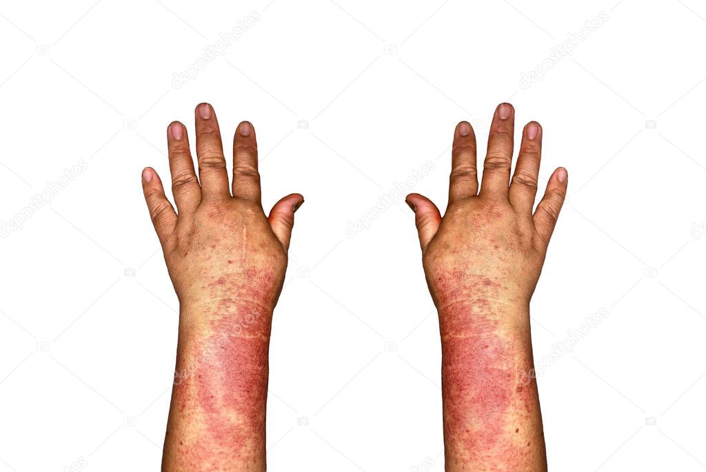 Bilateral edema of upper limbs. Swollen hands and arms of Asian woman. Isolated on white.
