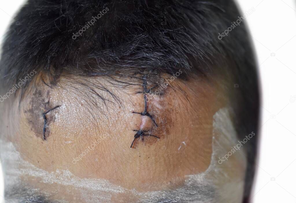 Stitched wound in forehead area of Southeast Asian child. Isolated on white 