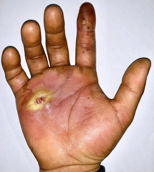 Absces Okolní Celulitidou Nebo Stafylokokovou Streptokokovou Kožní Infekcí Ruce Asijského — Stock fotografie