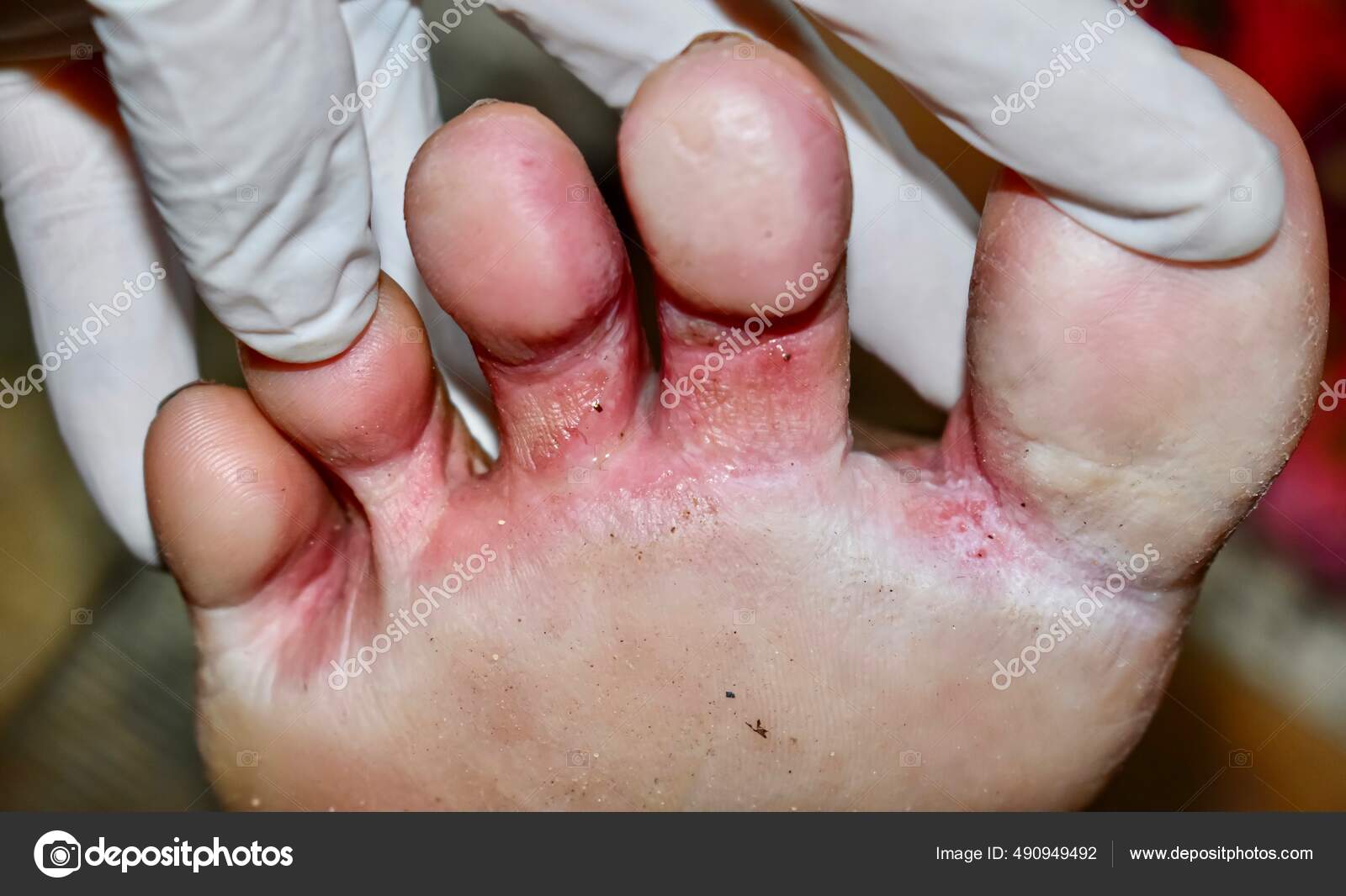 Fungal Infection Called Tinea Pedis Foot Asian Woman Itching