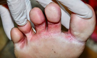 Asyalı kadının ayağında tinea pedis adı verilen mantar enfeksiyonu. Kaşındıran bir lezyon..