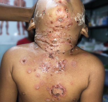 Myanmar Kliniği 'ndeki Güneydoğu Asyalı Birmanyalı çocuğun göğüs ve boynunda birden fazla impetigo ya da sayısız Staphylococcal veya Streptococcal deri enfeksiyonu var.