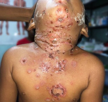 Multiple impetigoes or numerous Staphylococcal or Streptococcal skin infection in  chest and neckof Southeast Asian Burmese child in clinic of Myanmar clipart