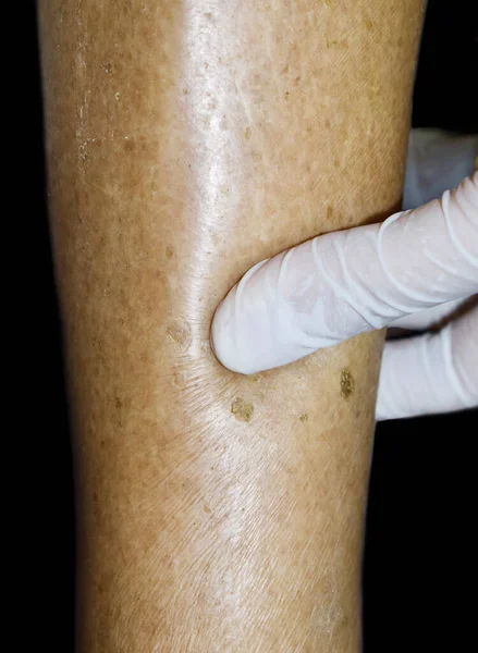 Pitting edema of lower limb. Swollen leg of Asian woman. Isolated on black.