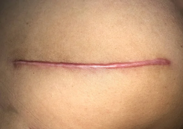 Neat Tidy Clean Hypertrophic Scar Straight Surgical Incision Top View — Stock Photo, Image