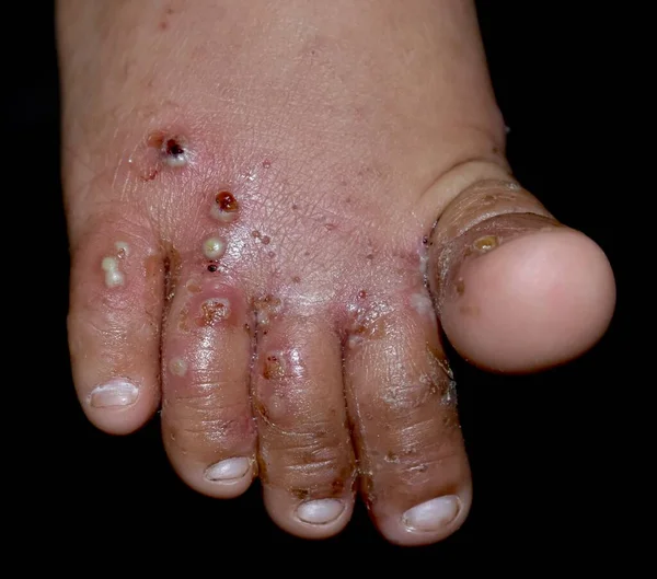 在东南亚 缅甸儿童的脚部有继发性或重叠的细菌感染和脓肿的疥疮 一种由螨引起的传染性皮肤病 被隔离在黑暗中 — 图库照片