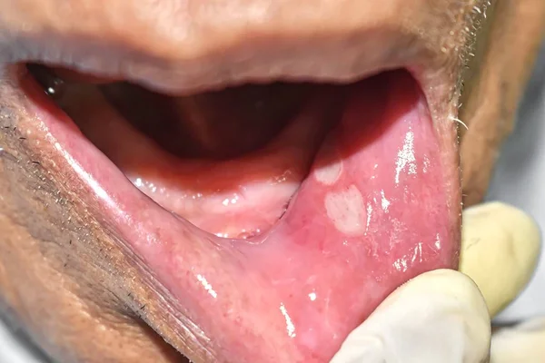 Aphthous Ulcer Stress Ulcer Mouth Asian Child — 图库照片