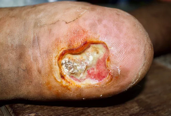 Diabetes Foot Ulcer Foot Asian Patient Detailní Pohled — Stock fotografie