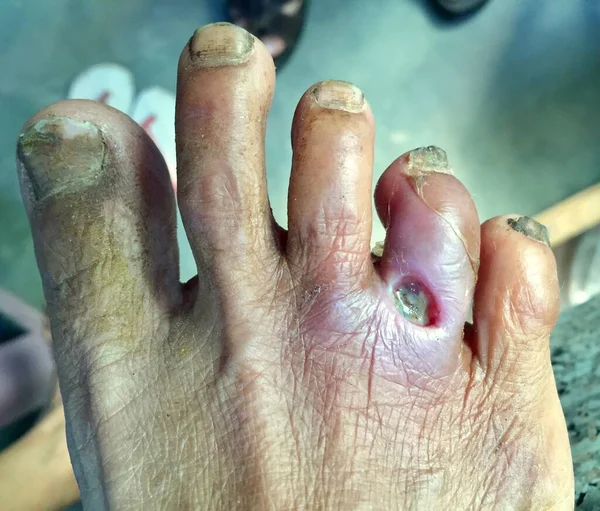 Diabetes Foot Ulcer Foot Asian Patient Detailní Pohled — Stock fotografie