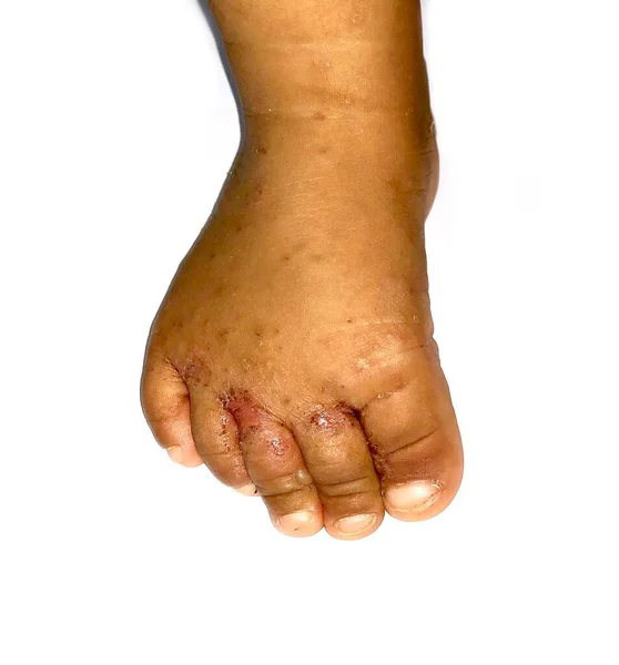 Scabies Infestation Δευτερογενή Επιβάλλονταν Βακτηριακή Λοίμωξη Και Φλύκταινες Στα Πόδια — Φωτογραφία Αρχείου