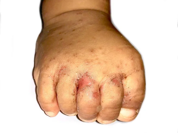 Scabies Infestation Secondary Superimposed Bacterial Infection Pustules Foot Southeast Asian — Fotografia de Stock