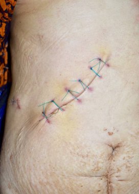 Yaşlı bir kadının karnındaki eğimli kesikte naylon dikişler. Yakın görünüm. 