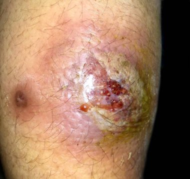 Asyalı Birmanyalı erkek hastanın sırtında büyük yakut ya da Staphylococcal, Streptococcal deri enfeksiyonu..