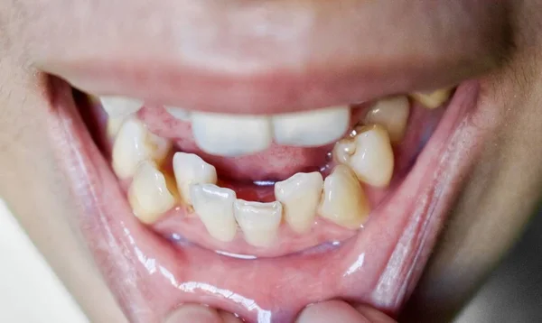 アジア人の歯を積み重ねたり重ねたり 混雑歯とも呼ばれる クローズアップビュー — ストック写真