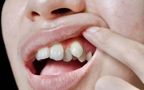 Stacked or overlapping canine teeth of Asian man. Also called crowded teeth. Closeup view.