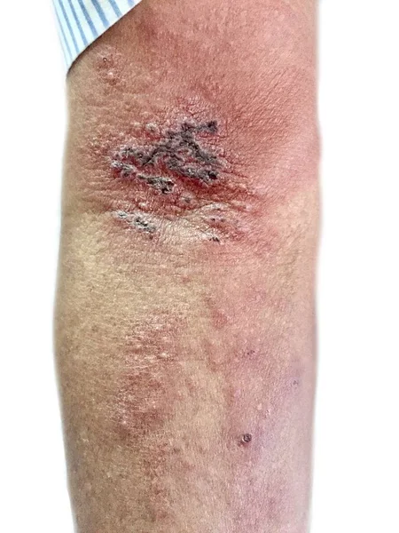 Herpes Simplex Infezione Braccio Giovane Asiatico Piccole Dolorose Vescicole — Foto Stock