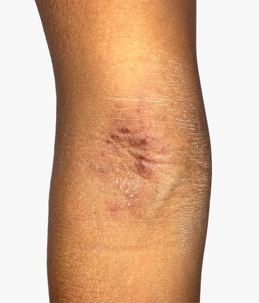 Itching skin lesions on upper limb of Asian child.