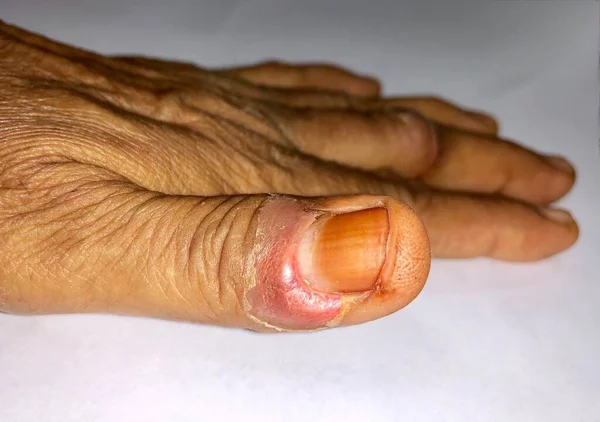 亚洲老年妇女的拇指上有个假名 这是一种痛苦的病痛 — 图库照片