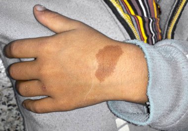 Asyalı çocuğun elinde düzensiz şekilli büyük bir doğum lekesi. Koyu renkli yama.