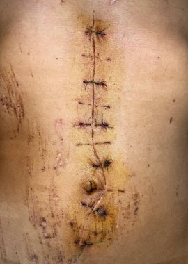 Laparotomi ya da Asyalı adamın karnında orta hat kesiği. Yakın görünüm.