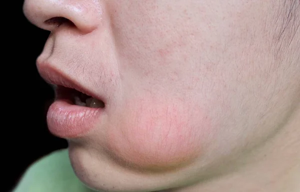 Swelling Cheek Asian Man Abscess Formation — Stock Photo, Image