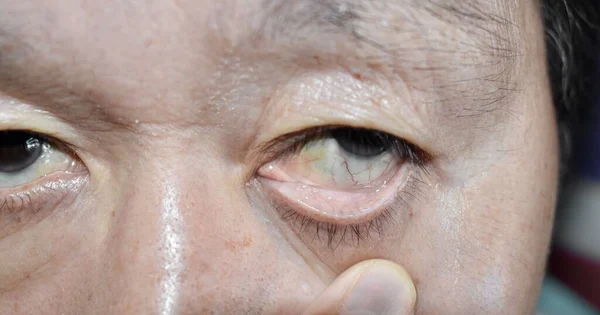 Pale Skin Asian Elderly Man Sign Anemia Pallor Eyelid Closeup — Stock Photo, Image