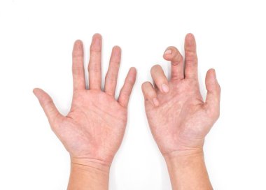 Asyalı genç bir adamın normal eliyle karşılaştırıldığında Ulnar el pençe. Ayrıca 